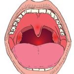 Tonsil Problem in Hindi