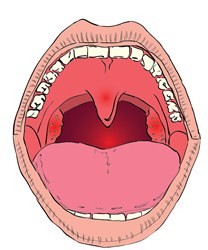 Tonsil Problem in Hindi